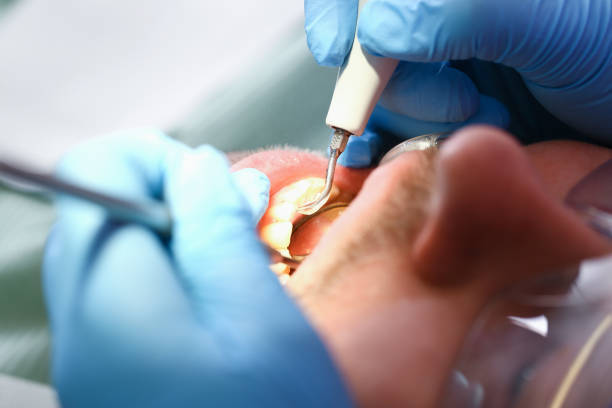 Best Knocked-Out Tooth (Avulsed Tooth) Treatment in Camp Hill, PA