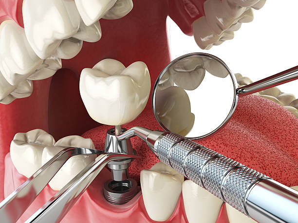 Best Emergency Dental Care for Sports Injuries in Camp Hill, PA